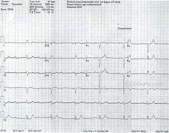 1st Degree Heart Block Ecg Findings Photos Idea